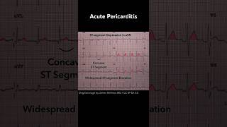 Acute Pericarditis ECG STsegment depression in aVR [upl. by Mohamed]