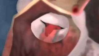 Aortic Valve Stenosis 3D Video on Healthline com [upl. by Puto]