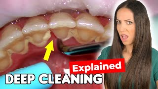 Dental Hygienist Explains Deep Cleaning Procedure [upl. by Attekal120]