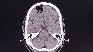 Dermoid cyst  ruptured   rare intracranial lesion [upl. by Solracsiul]