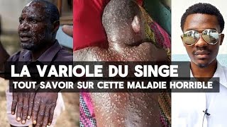 LA VARIOLE DU SINGE  tout savoir sur cette maladie encore appelée MPOX [upl. by Adniroc195]