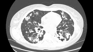 STR Cardiothoracic Case Webinar 10212021 [upl. by Mayhew]