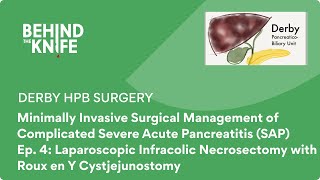 Derby HPB Surgery  Ep 4 Laparoscopic Infracolic Necrosectomy with Roux en Y Cystjejunostomy [upl. by Milicent]