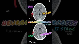 Neurocysticercosis NCC in CT Scan shortshorts ytshorts youtubeshorts radiology medical [upl. by Atinniuq]