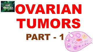 OVARIAN TUMORS  Part 1  Classification [upl. by Engelhart]