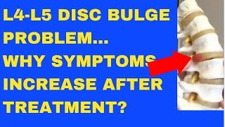 Why Does L4 L5 Disc Bulge Symptom Increase After Treatment  Answered by Chiropractor in Vaughan [upl. by Navanod723]