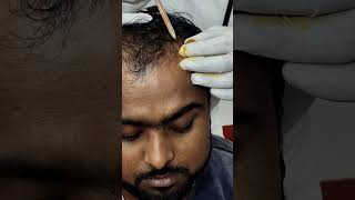 hair loss treatment Hair regrowthlow price prp and GFC treatment  clinic9734984030youtubereel [upl. by Enerehs]