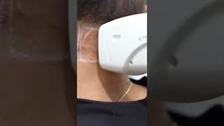 Laser Hair Removal Treatment by Dr Adil Hamayun [upl. by Gareth714]