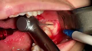 partially impacted lower wisdom tooth extraction [upl. by Llenaj]