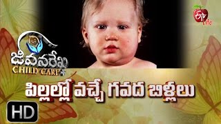 Jeevanarekha child care  Mumps in the kid  20th April 2017  జీవనరేఖ చైల్డ్ కేర్ [upl. by Tavie942]