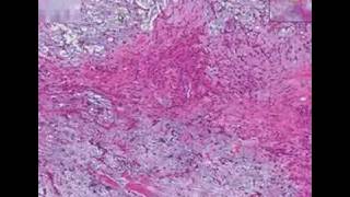 Histopathology Salivary glandPleomorphic adenoma mixed tu [upl. by Moffat321]