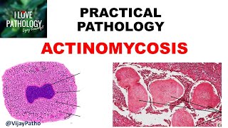 Practical Pathology ACTINOMYCOSIS [upl. by Maud]