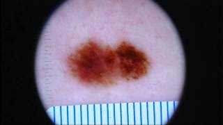 New breakthrough in skin cancer treatment [upl. by Aiyram]