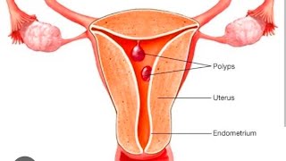 Endometrial polyp sonography [upl. by Marcy]