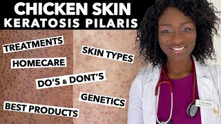 Keratosis Pilaris Chicken Skin  Treating Dry Bumpy Skin  Special Tips for Black Skin  Ask Doctor [upl. by Anuahsal]