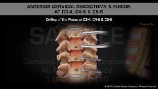 Anterior Cervical Discectomy amp Fusion at C34 C45 amp C56 [upl. by Ania]