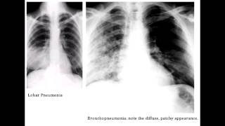 Lobar Pneumonia amp Bronchopneumonia  Organisms amp Characteristics [upl. by Outlaw]