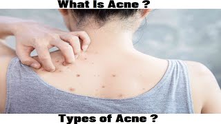 What Is Acne Types Of Acne [upl. by Yukio212]