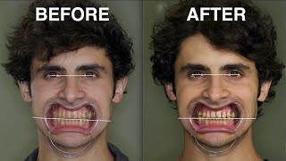 Success Canted Smile Corrected [upl. by Chapland190]