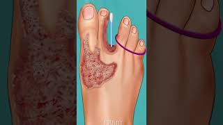 Foot Rashes Treatment I Asmr Animation Trick Infected Foot Treatment I shorts asmr animation [upl. by Rochus814]