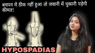 HYPOSPADIAS  बचपन में ठीक नहीं हुआ तो जवानी में चुकानी पड़ेगी कीमत [upl. by Suzi825]