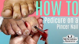 👣HOW TO DO A PEDICURE on a Pincer Toenail👣 [upl. by Zinck]