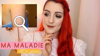 Ma maladie de peau  je vous dis tout 😫 Kératose Pilaire amp mes conseils   LOdoesmakeup [upl. by Assilram]