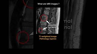 T1 weighted image – Pathology spine Quiz 14 radiologychannel007 [upl. by Ellehsar]