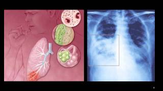 Atypical Pneumonia [upl. by Gallagher]