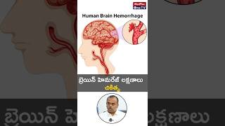 What is a Brain Hemorrhage and Treatments You Need to Know l Dr S Ramesh shorts MedPlusONETV [upl. by Nerrat]