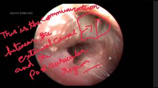 POST AURICULAR SINUS [upl. by Dnalerb]