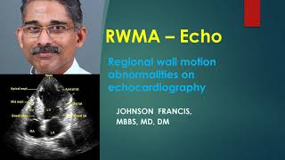 RWMA Echo [upl. by Mendez]