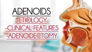 ADENOIDS ETIOLOGY CLINICAL FEATURESADENOIDECTOMY [upl. by Aihsenot997]