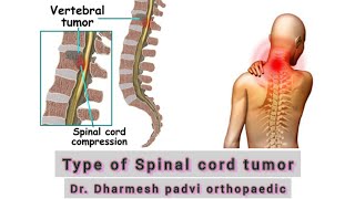 Type Of Spinal cord tumor Dr Dharmesh padvi [upl. by Armillda]