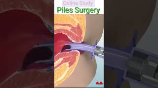 Piles Surgery 👨‍⚕️ [upl. by Ahsieat]