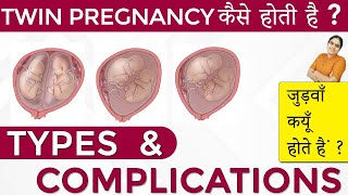 Twins Pregnancy Types Dichorionic Conjoined Monochorionic Diamniotic Monochorionic Monoamniotic [upl. by Lednar]