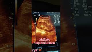 Multiple nephrolithiasis ultrasound showing video  kidney stones ultrasound ultrasound pregnant [upl. by Malkah]