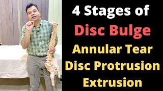 Stages of Disc Bulge Annular Tear Disc Protrusion Disc Extrusion Herniated Disc Stages [upl. by Eissat]