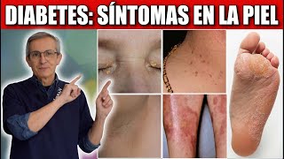 10 SINTOMAS de DIABETES en la PIEL [upl. by Ginsburg890]