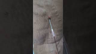 Varicose Veins treatment by Dr Hussain at Hussaingreekcliniccom without surgery drhussain [upl. by Akela]