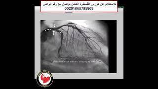 Coronary deceptive LCX lesion Dr Alaa Nasr 2024 [upl. by Ellehcit26]