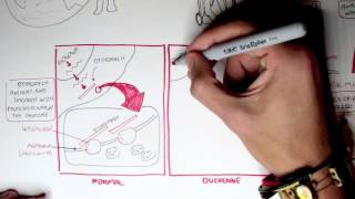 Muscular Dystrophy  Duchenne Becker and Mytonic [upl. by Chong]