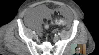 CT Epiploic Appendages Discussion [upl. by Lamdin338]