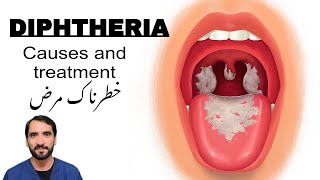 Diphtheria  Symptoms Causes and treatment [upl. by Nnyliak]