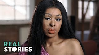 ACID ATTACK My Story Crime Documentary  Real Stories [upl. by Anazus438]