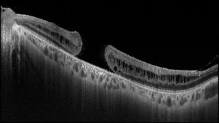 Macular Hole Surgery [upl. by Evangelia847]