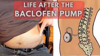 From uncontrollable spasms to relaxed limbs  Life before and after a Baclofen Pump [upl. by Zephaniah]