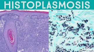 Histoplasmosis Two Extreme Examples Pseudotumor amp Zero Inflammation [upl. by Worlock]