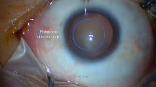 Vitrectomía para remover flotadores  Vitrectomy for floaters  Dr Aureliano Moreno [upl. by Nolasba]