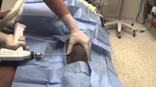 Hip Dislocation Reduction and Traction Pinning [upl. by Sievert]